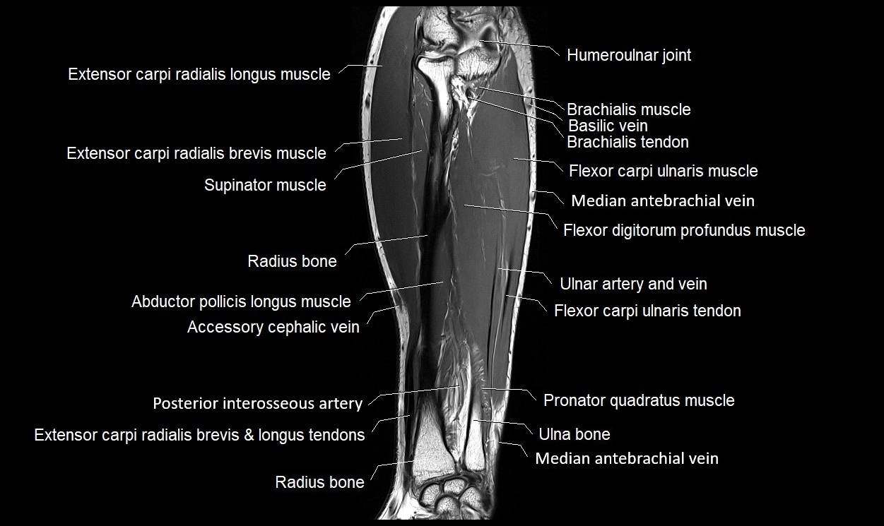 MRI 3T forearm coronal cross sectional anatomy image 17.webp